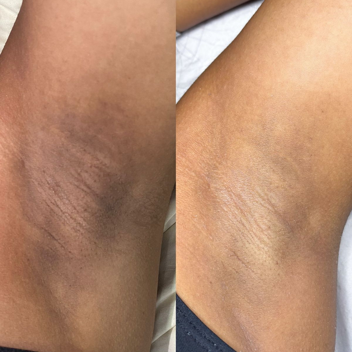 SnowBleach™️| Crema sbiancante per il corpo | Veiggara.