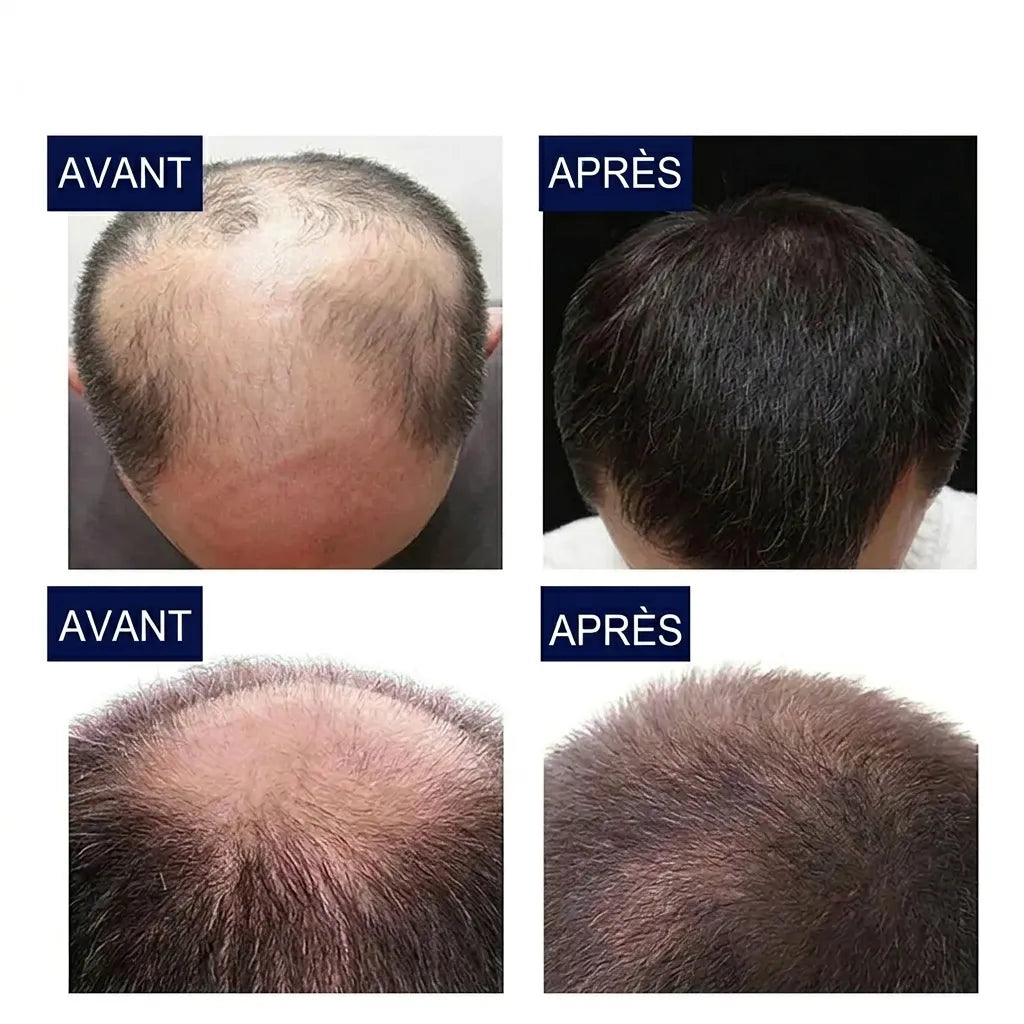 Ginger Hair | Huile pour la croissance des cheveux et le traitement de la calvitie | Veiggara