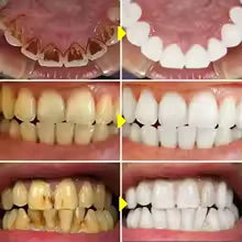 Penna sbiancante per denti - SnowTooth | Veiggara